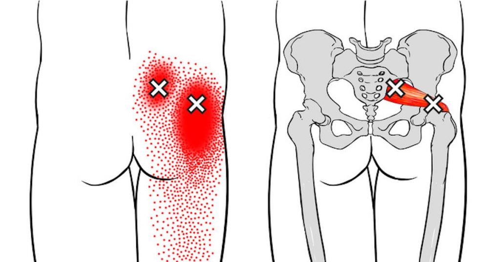 sindrome piriforme